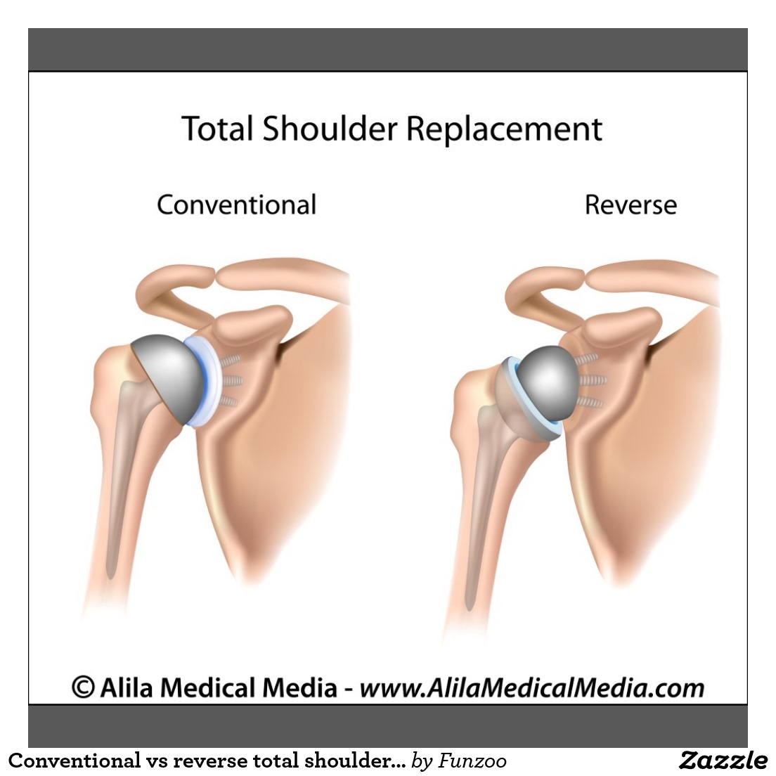 Conventional Vs. Reverse Total Shoulder Replacement