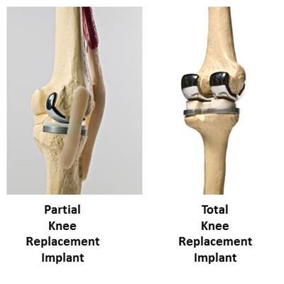 Knee Replacement Implant Comparison