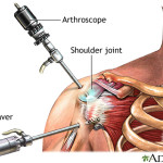shoulder arthroscopy